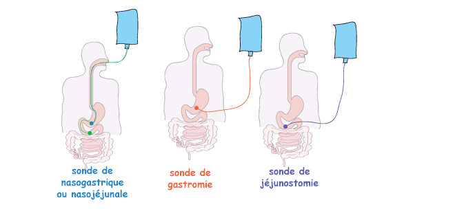 Alimentation enteral